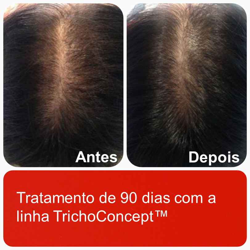 antes e depois do tratamento de 90 dias com a linha TrichoConcep