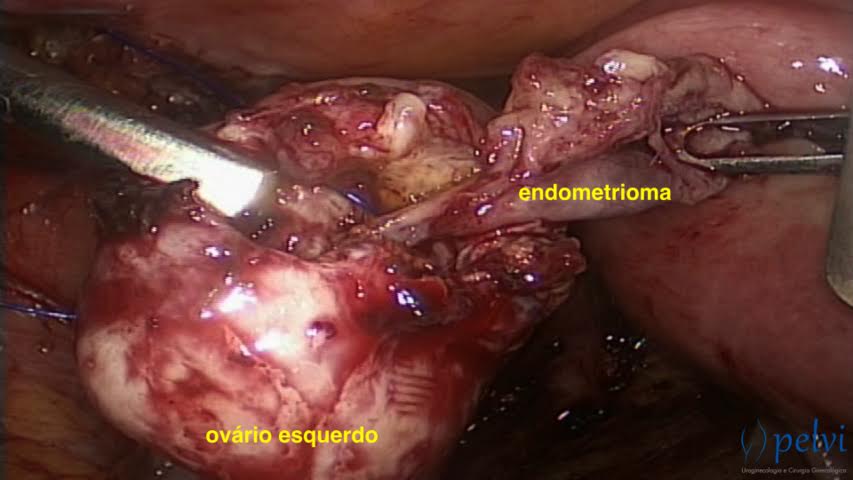 retirada da pseudocápsula do endometrioma ovariano 