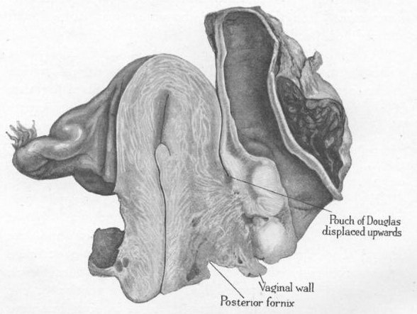 Adenomioma (adenomiose e endometriose invasiva) do espaço reto-vaginal.